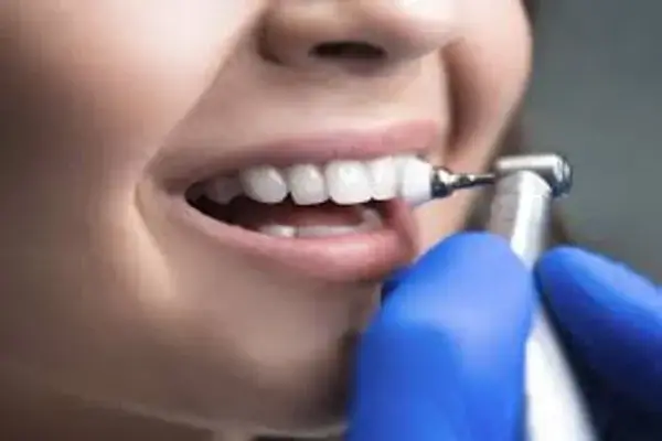 Cada Cuánto Necesitas una Limpieza Dental