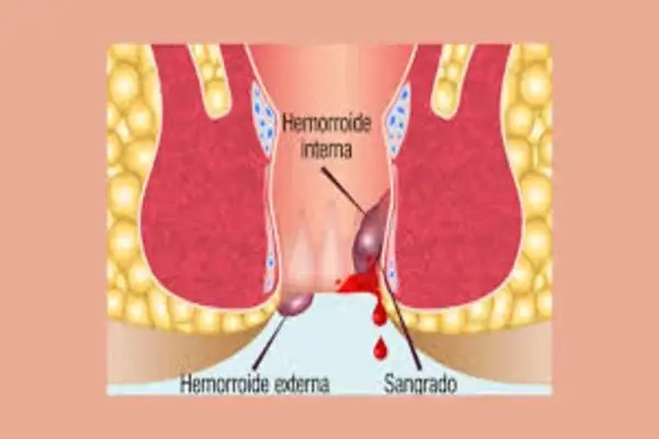 Tipos de hemorroides Cómo identificar las internas y externas