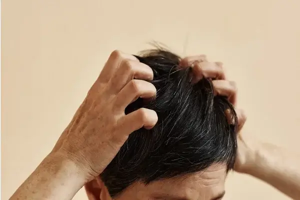 Picor en el cuero cabelludo causas médicas que no son caspa