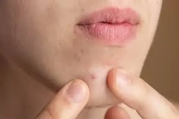 Acné por el gimnasio