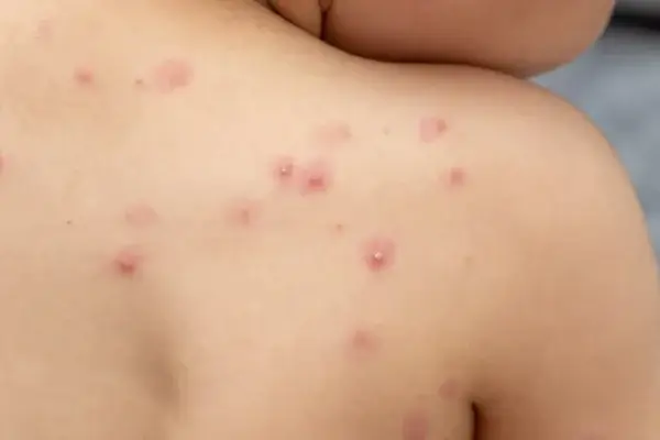 Qué es la variante Clado Ib de la mpox