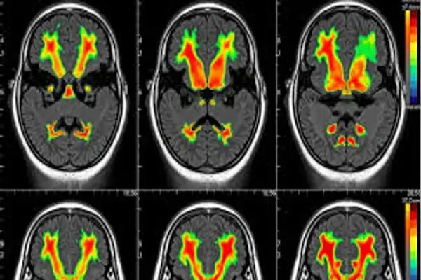 Cerebro procesa lenguaje incluso bajo anestesia