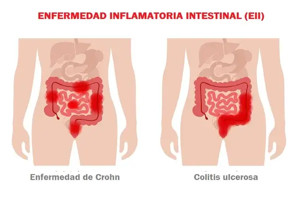 Enfermedad Inflamatoria Intestinal síntomas