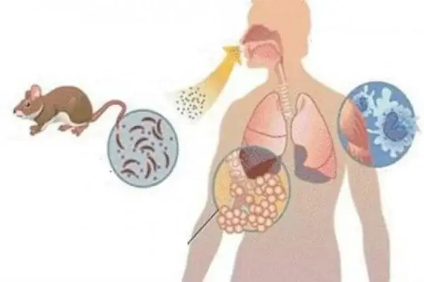 Qué es el hantavirus