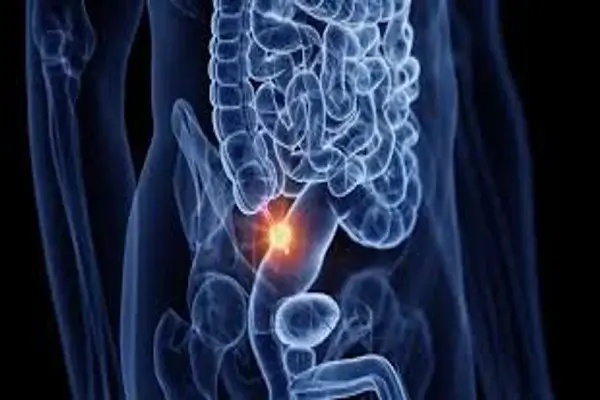 Cáncer de apéndice