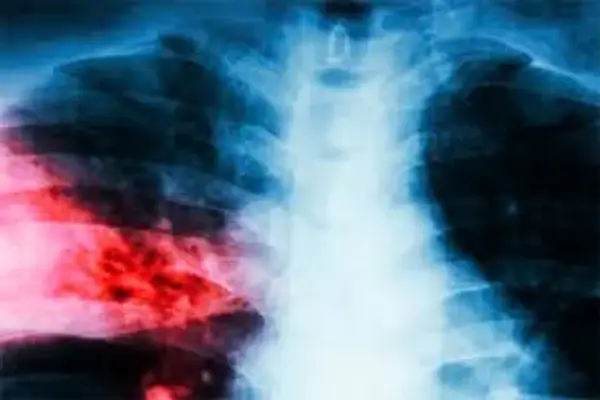 La clave contra el cáncer de pulmón