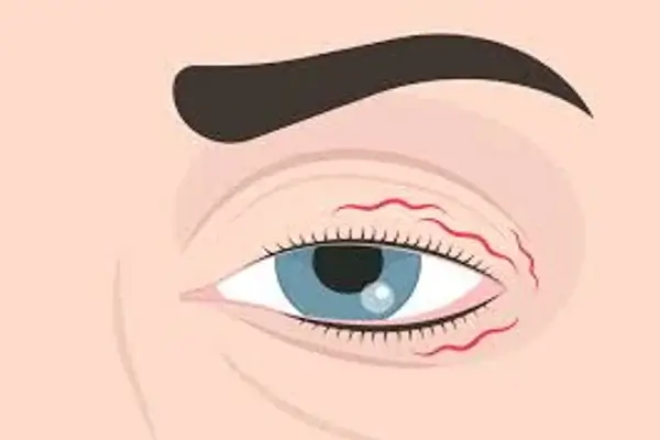 Por qué tiembla el ojo