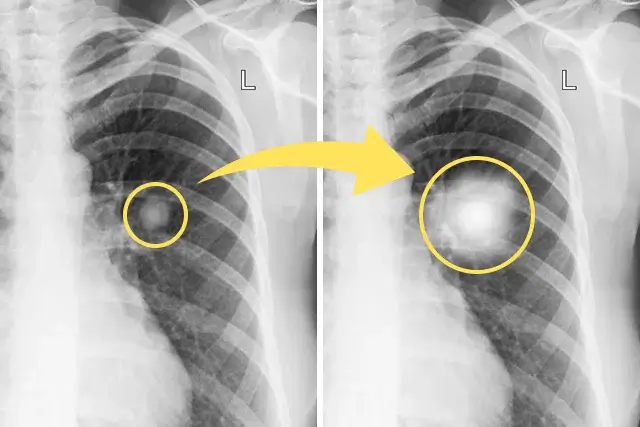 Qué es un nódulo pulmonar